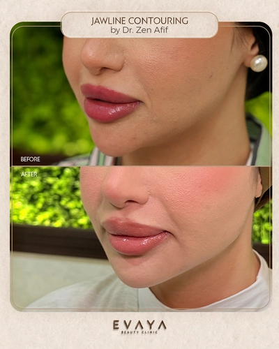 Jaw-line-Contouring_Dr-Zen