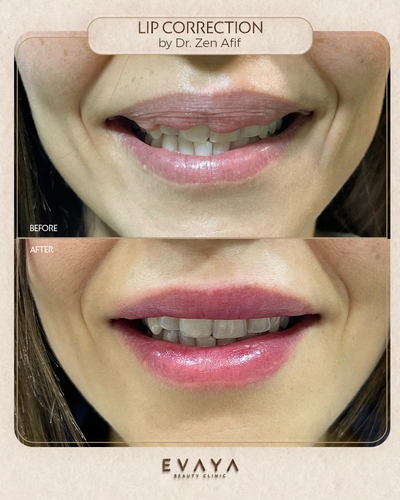 Lip Correction