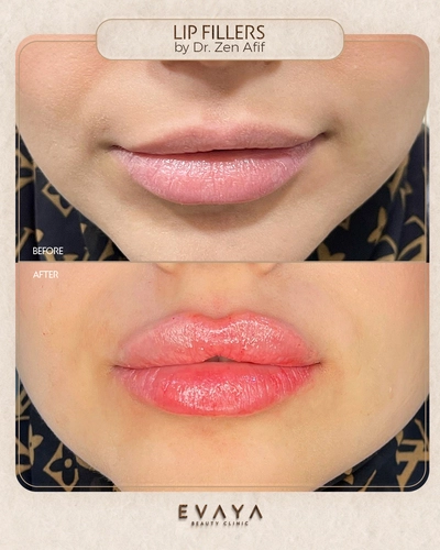 Lip Fillers