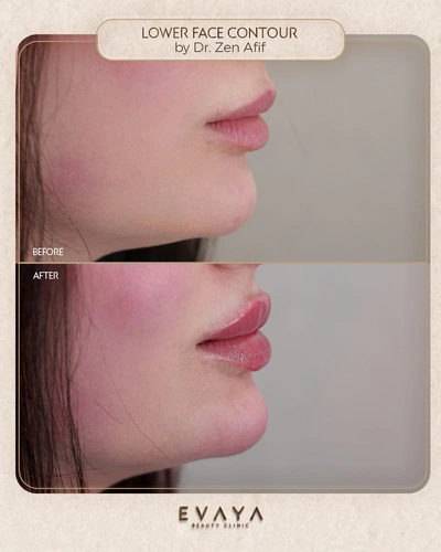 Lower Face Contouring_2_Dr Zen