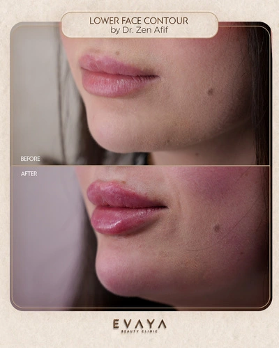 Lower-Face-Contouring_Dr-Zen