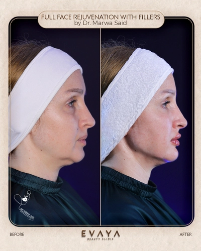 full face rejuvenation by dr marwa