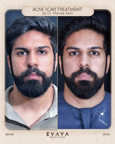 Acne scar treatment by dr marwa