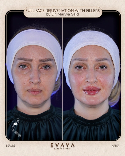 full face rejuvenation by dr marwa