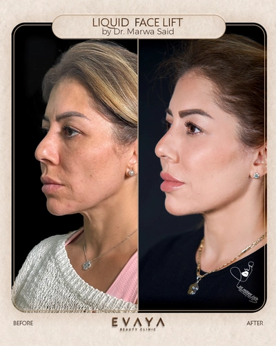 liquid facelift by dr marwa