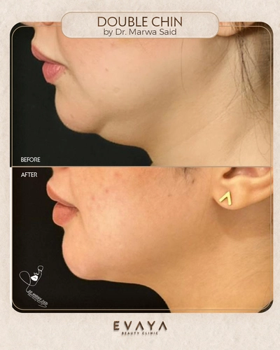 double chin by dr marwa