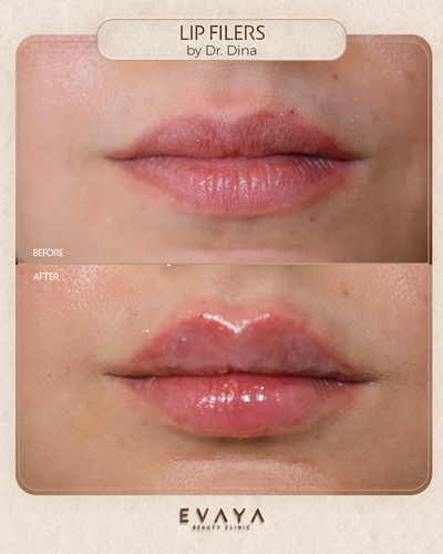 full face contouring by dr dina Elyamany