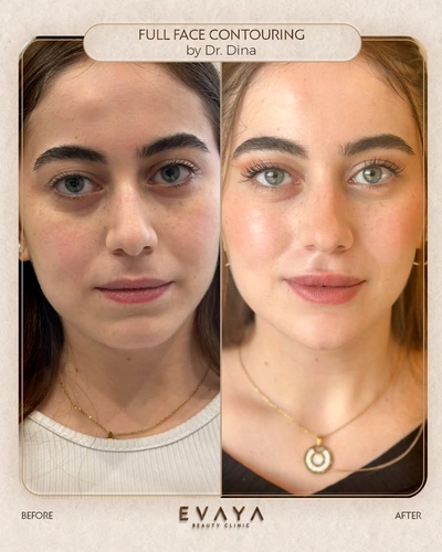full face contouring by dr dina Elyamany