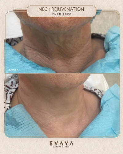 neck rejuvenation by dr dina Elyamany