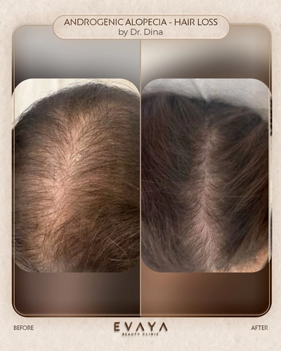androgenic alopecia by dr dina Elyamany