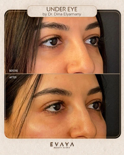 under eye by dr dina Elyamany