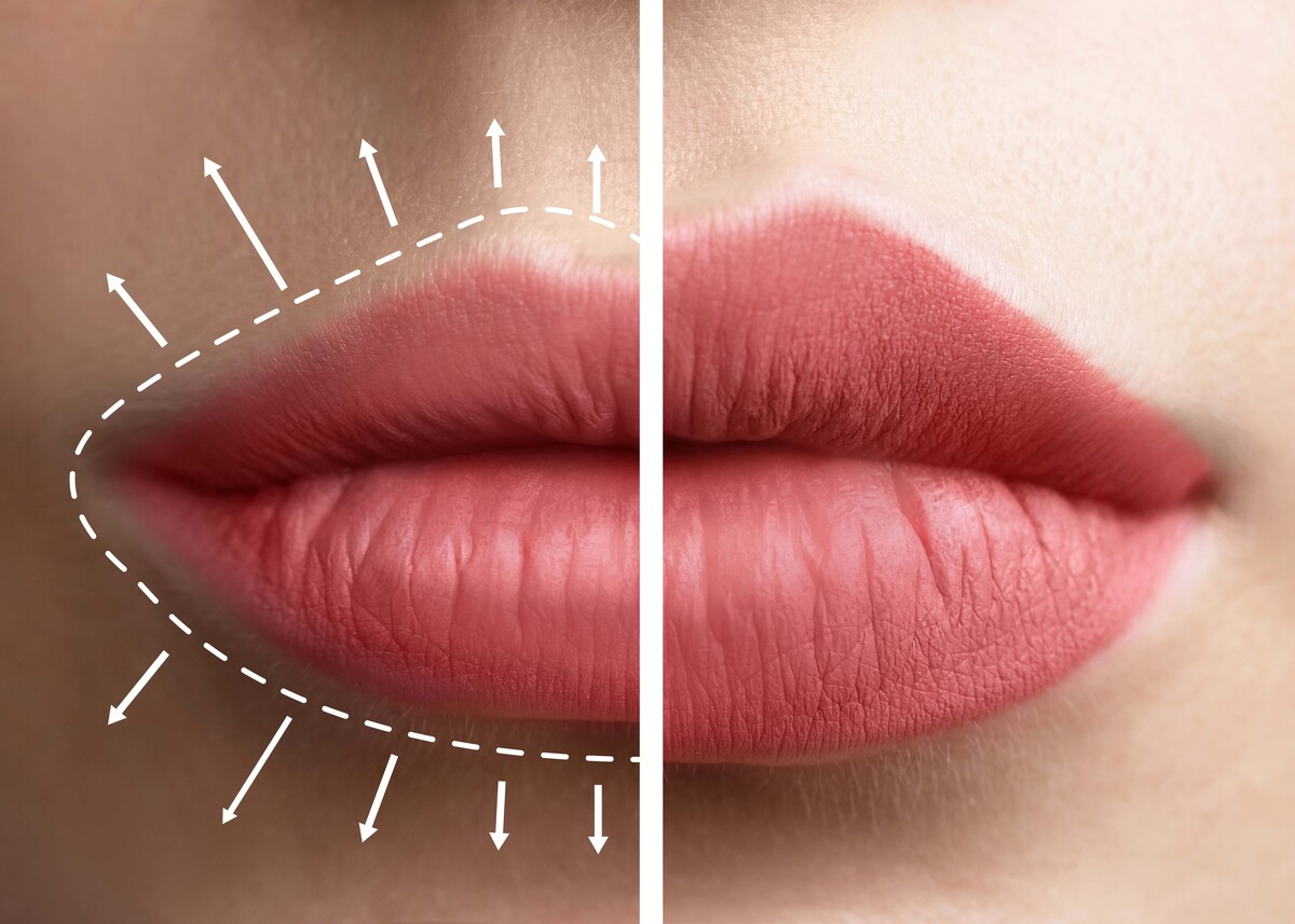 lips augmentation procedure