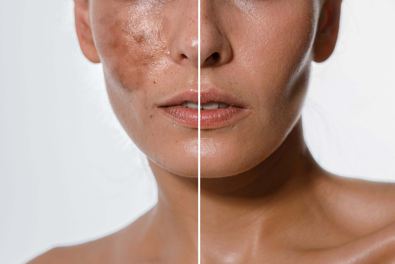 pigmentation