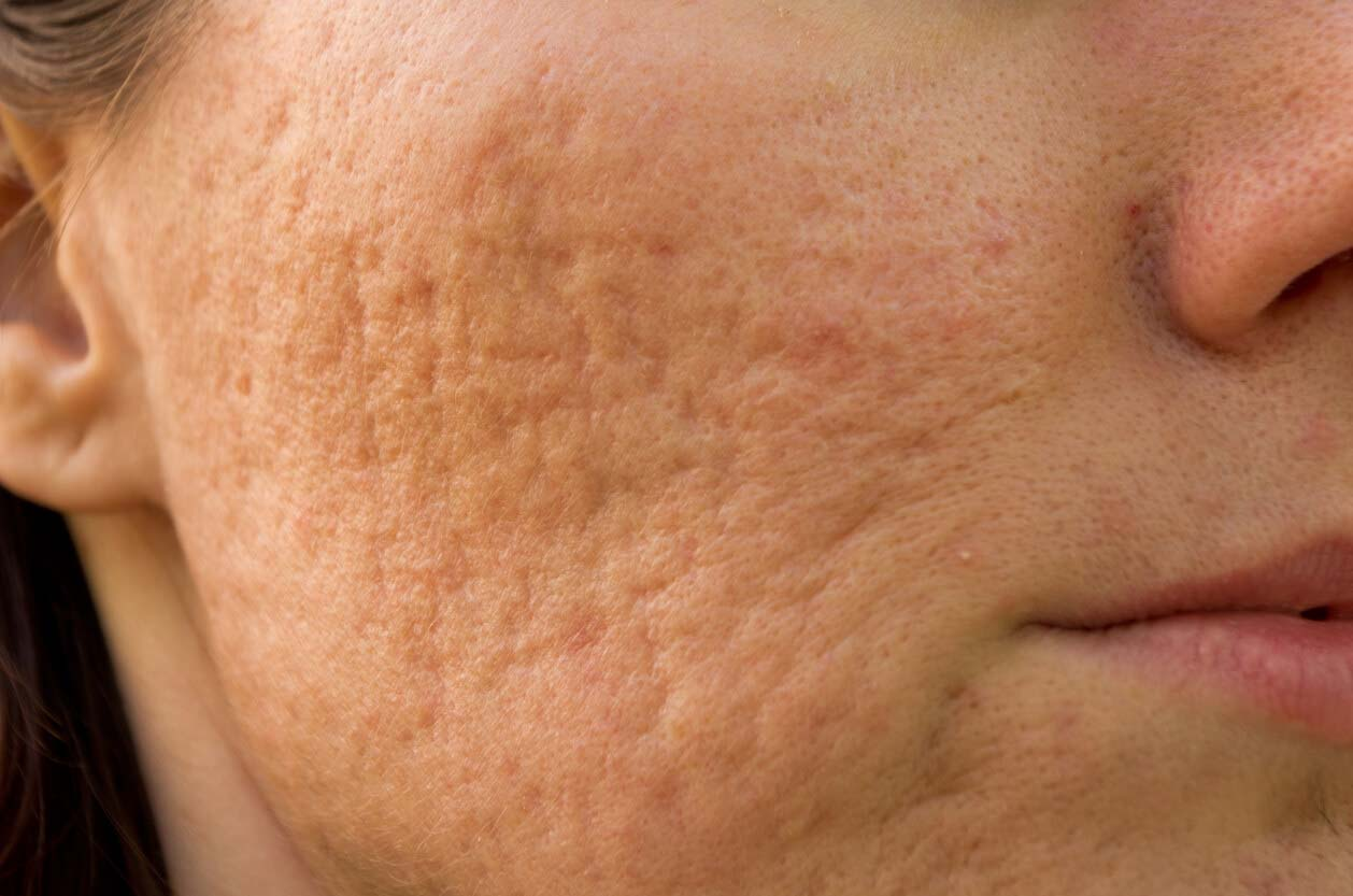 Pore Refinement
