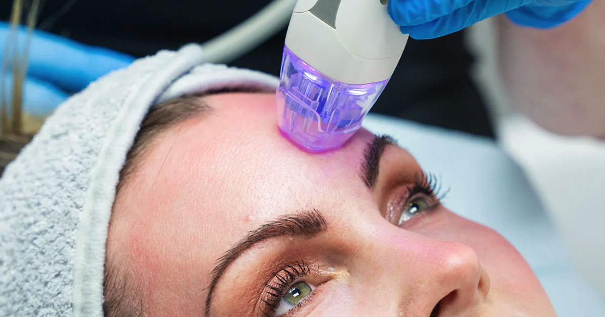 Micro needling RF Needling