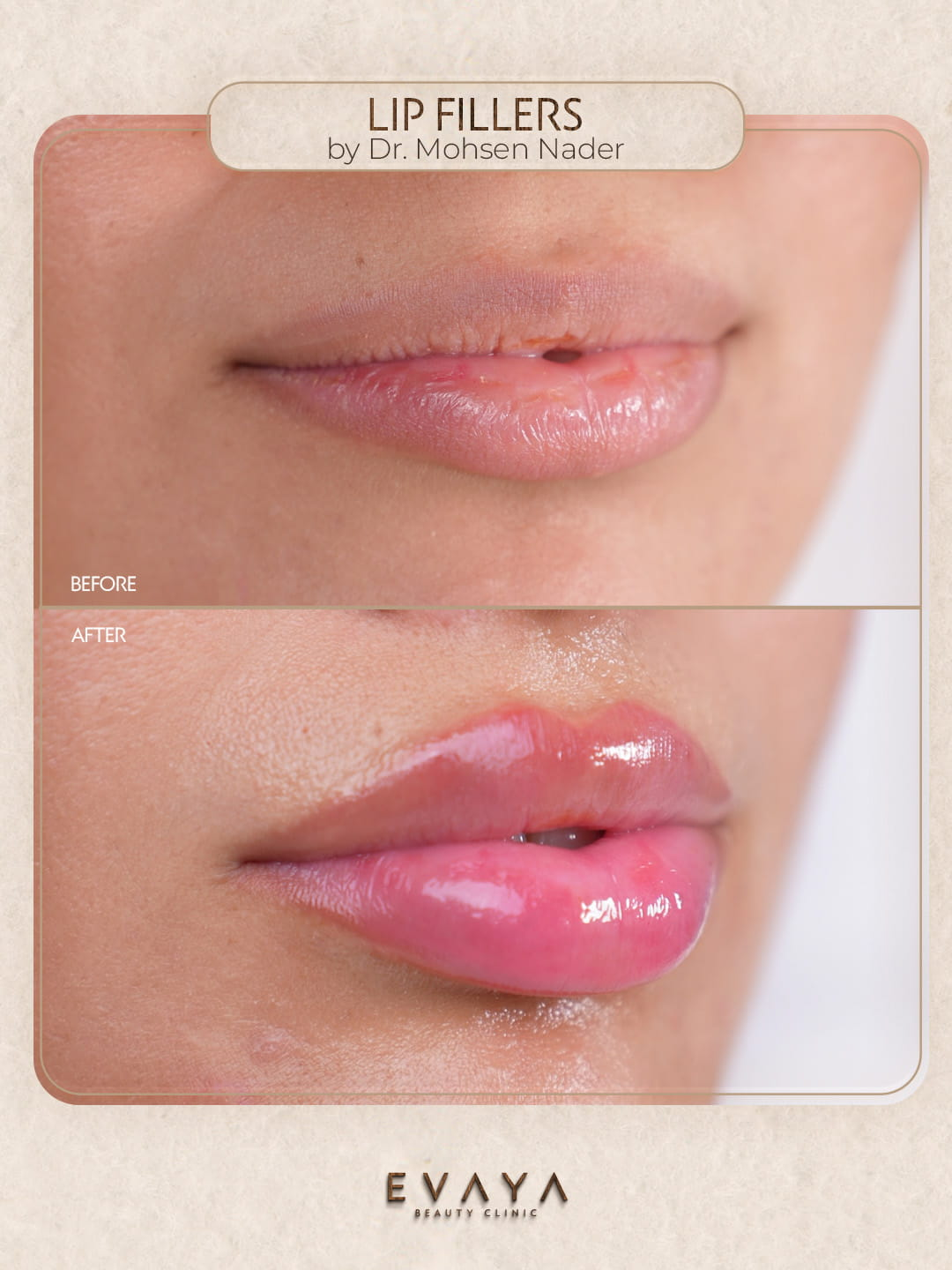 Lip fillers - mohsen-1.jpg
