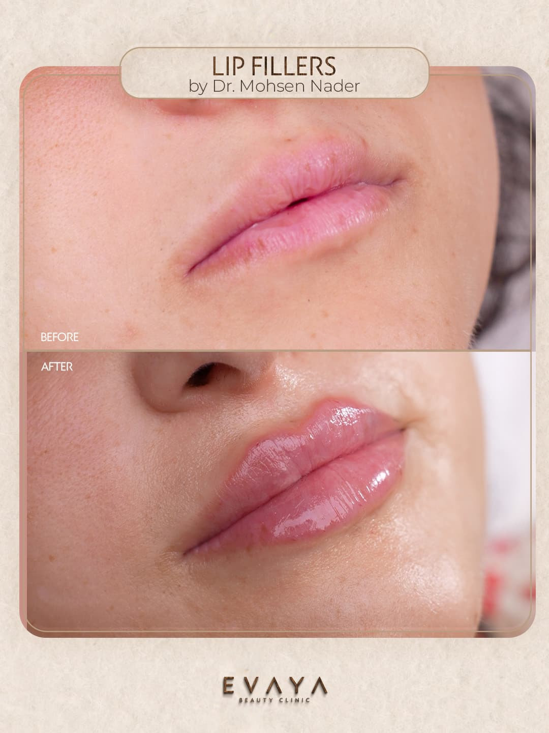 Lip fillers - mohsen.jpg